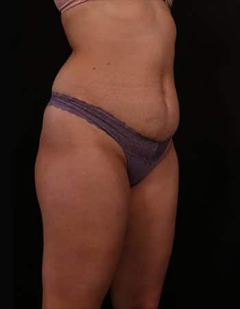 Before Image: Tummy Tuck (Abdominoplasty) - right-front-oblique