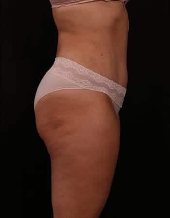 After Image: Tummy Tuck (Abdominoplasty) - right-side