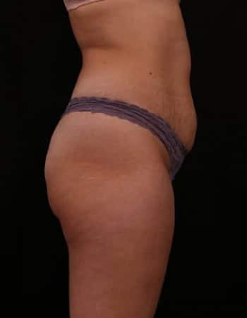 Before Image: Tummy Tuck (Abdominoplasty) - right-side