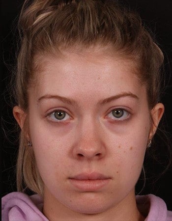 After Image: Facial Fat Grafting - front