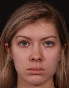 Before Image: Facial Fat Grafting