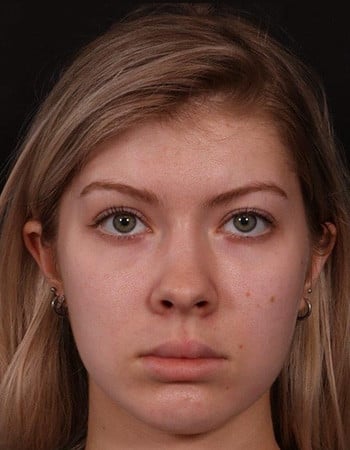 Before Image: Facial Fat Grafting - front