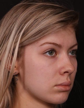 After Image: Brow Lift - right-front-oblique