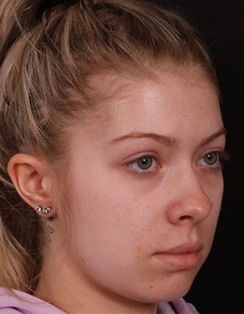 Before Image: Brow Lift - right-front-oblique