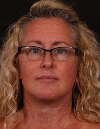 After Image: Lower Facelift - front