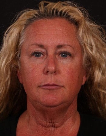 Before Image: Lower Facelift - front