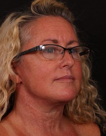 After Image: Lower Facelift - right-front-oblique