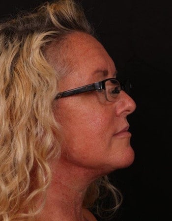 After Image: Lower Facelift - right-front-oblique
