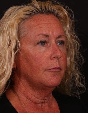 Before Image: Lower Facelift - right-front-oblique