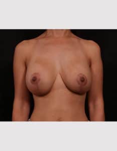 After Image: Breast Lift with Augmentation