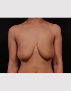 Before Image: Breast Lift with Augmentation