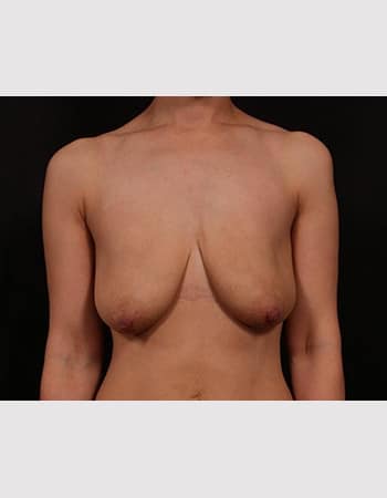 Before Image: Breast Lift with Augmentation - front