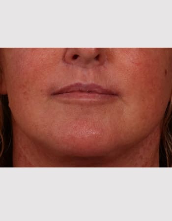 After Image: Lip Lift - front