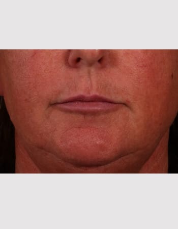 Before Image: Lip Lift - front