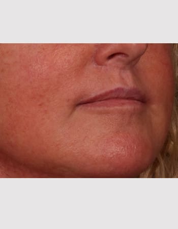 After Image: Lip Lift - right-front-oblique