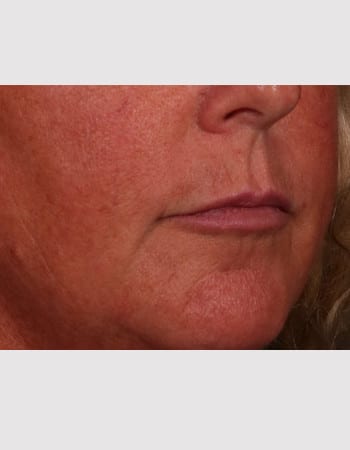 Before Image: Lip Lift - right-front-oblique