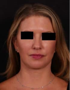 After Image: Full Face Lift, Upper/Lower Blepharoplasty, Buccal Fat Removal and Brow Lift