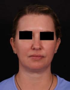 Before Image: Full Face Lift, Upper/Lower Blepharoplasty, Buccal Fat Removal and Brow Lift
