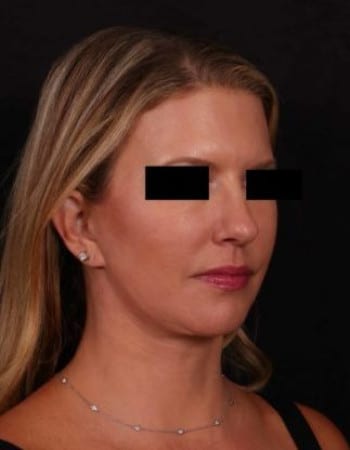 After Image: Full Face Lift, Upper/Lower Blepharoplasty, Buccal Fat Removal and Brow Lift - right-front-oblique