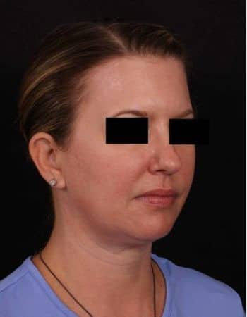 Before Image: Full Face Lift, Upper/Lower Blepharoplasty, Buccal Fat Removal and Brow Lift - right-front-oblique