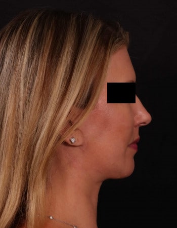 After Image: Full Face Lift, Upper/Lower Blepharoplasty, Buccal Fat Removal and Brow Lift - right-side