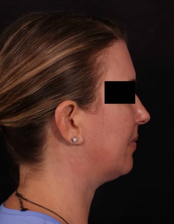 Before Image: Full Face Lift, Upper/Lower Blepharoplasty, Buccal Fat Removal and Brow Lift - right-side