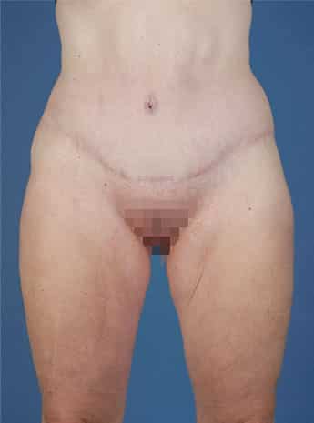 After Image: Tummy Tuck (Abdominoplasty) - front