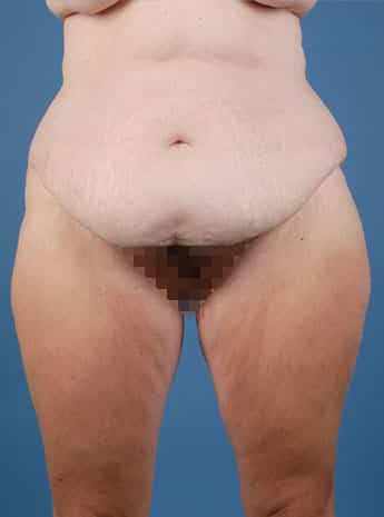 Before Image: Tummy Tuck (Abdominoplasty) - front