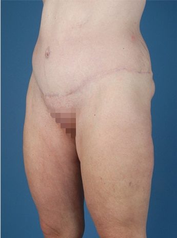 After Image: Tummy Tuck (Abdominoplasty) - left-front-oblique