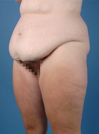 Before Image: Tummy Tuck (Abdominoplasty) - left-front-oblique