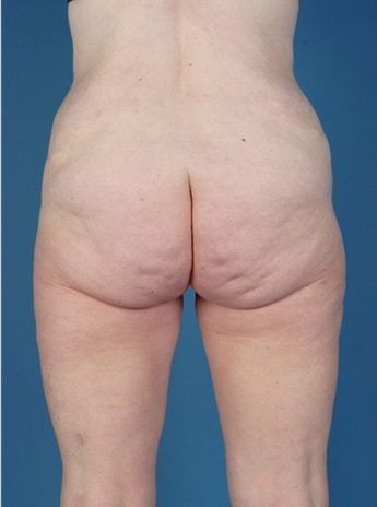 After Image: Tummy Tuck (Abdominoplasty) - back
