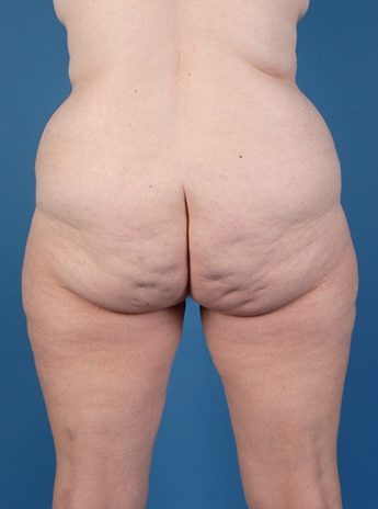 Before Image: Tummy Tuck (Abdominoplasty) - back