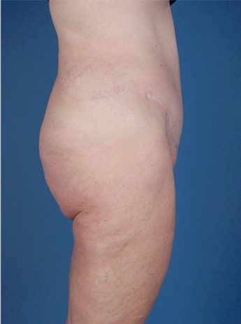 After Image: Tummy Tuck (Abdominoplasty) - right-side