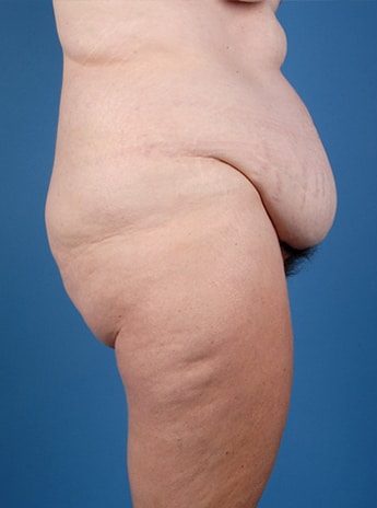 Before Image: Tummy Tuck (Abdominoplasty) - right-side