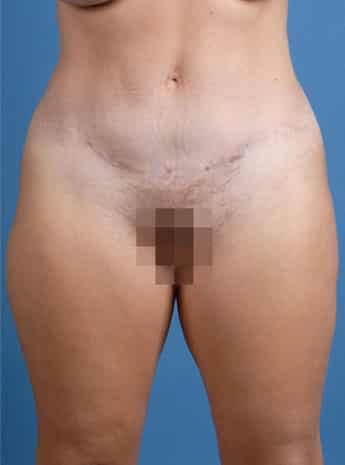 After Image: Tummy Tuck (Abdominoplasty) - front