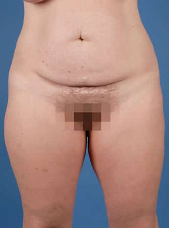 Before Image: Tummy Tuck (Abdominoplasty) - front