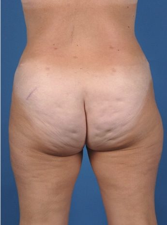 After Image: Tummy Tuck (Abdominoplasty) - back