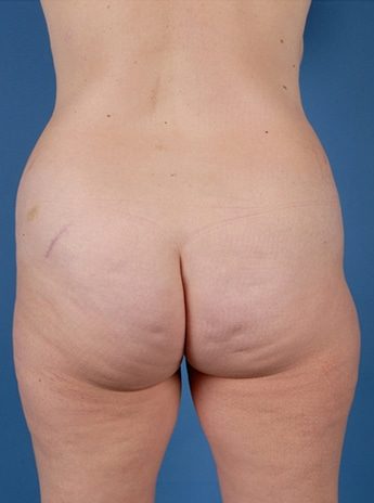 Before Image: Tummy Tuck (Abdominoplasty) - back