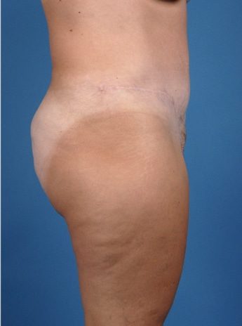 After Image: Tummy Tuck (Abdominoplasty) - right-side