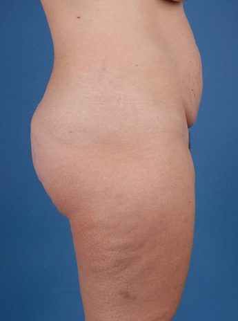 Before Image: Tummy Tuck (Abdominoplasty) - right-side