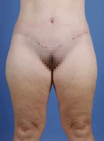 After Image: Body Lift - front