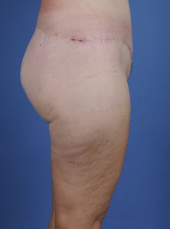 After Image: Body Lift - right-side