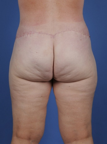 After Image: Body Lift - back