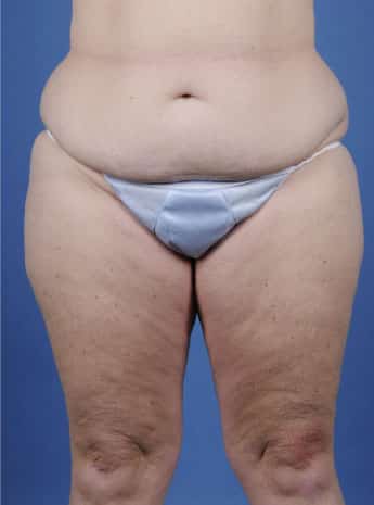 Before Image: Body Lift - front