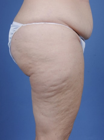 Before Image: Body Lift - right-side