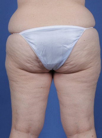 Before Image: Body Lift - back