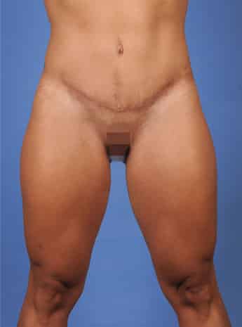 After Image: Body Lift - front