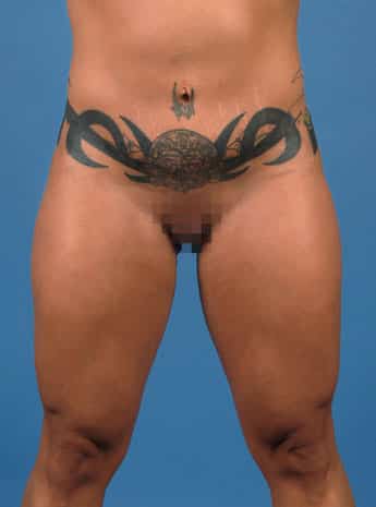 Before Image: Body Lift - front