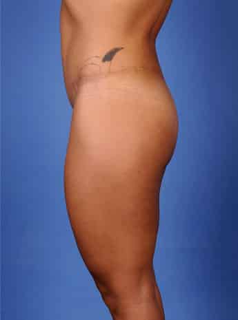 After Image: Body Lift - left-side