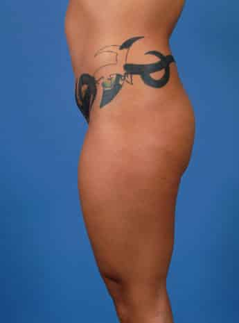 Before Image: Body Lift - left-side